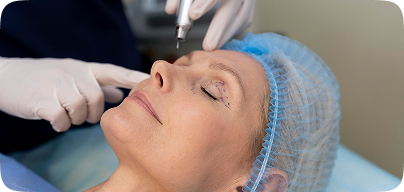 Бліферопластика